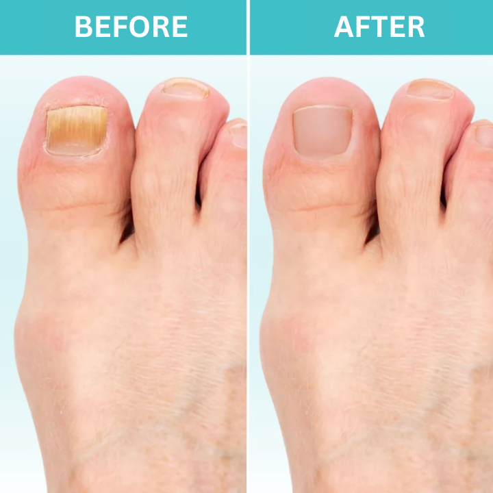FungiZap™ – Voor gezonde, heldere en sterke nagels zonder chemische middelen of dure behandelingen [50% Korting]
