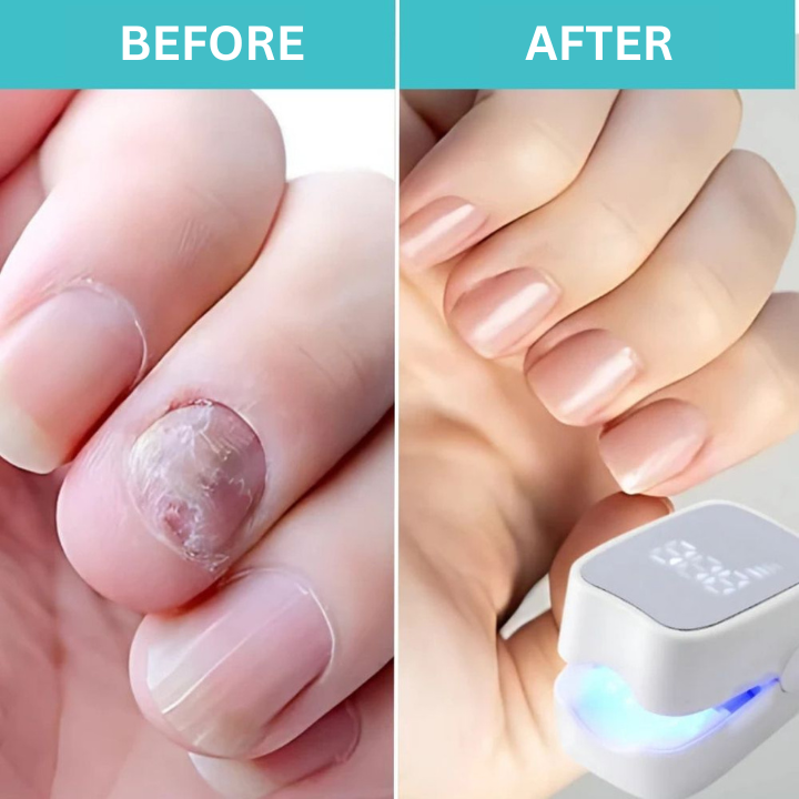 FungiZap™ – Voor gezonde, heldere en sterke nagels zonder chemische middelen of dure behandelingen [50% Korting]