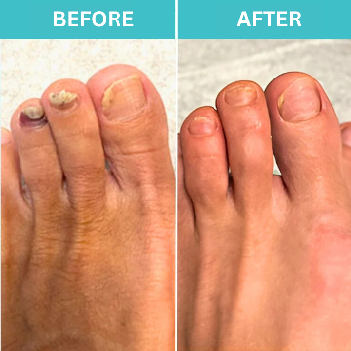 FungiZap™ – Voor gezonde, heldere en sterke nagels zonder chemische middelen of dure behandelingen [50% Korting]