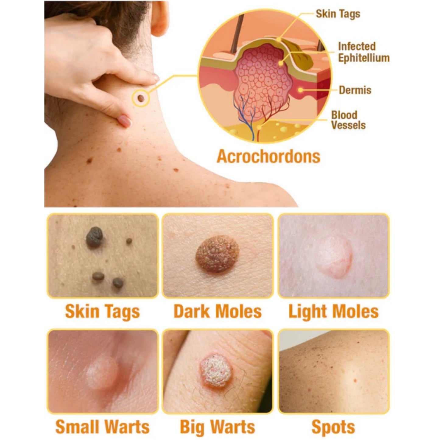 TagRemove™ - Effectieve verwijdering van wratten en huidgezwellen [1 + 1 Gratis]