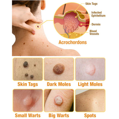 TagRemove™ - Effectieve verwijdering van wratten en huidgezwellen [1 + 1 Gratis]