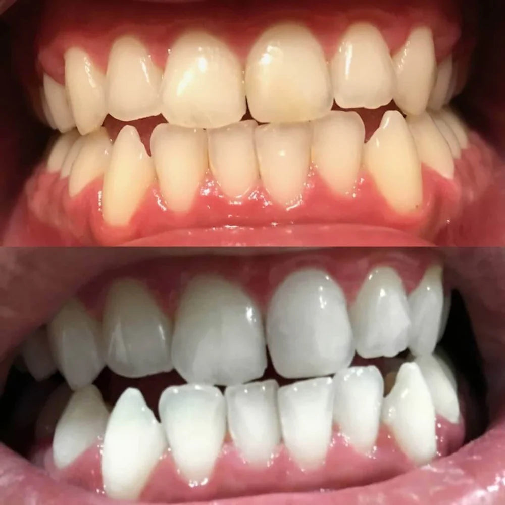 WhiteBoost™ – Straal uit met een glimlach die elke kamer domineert [1 + 1 Gratis]