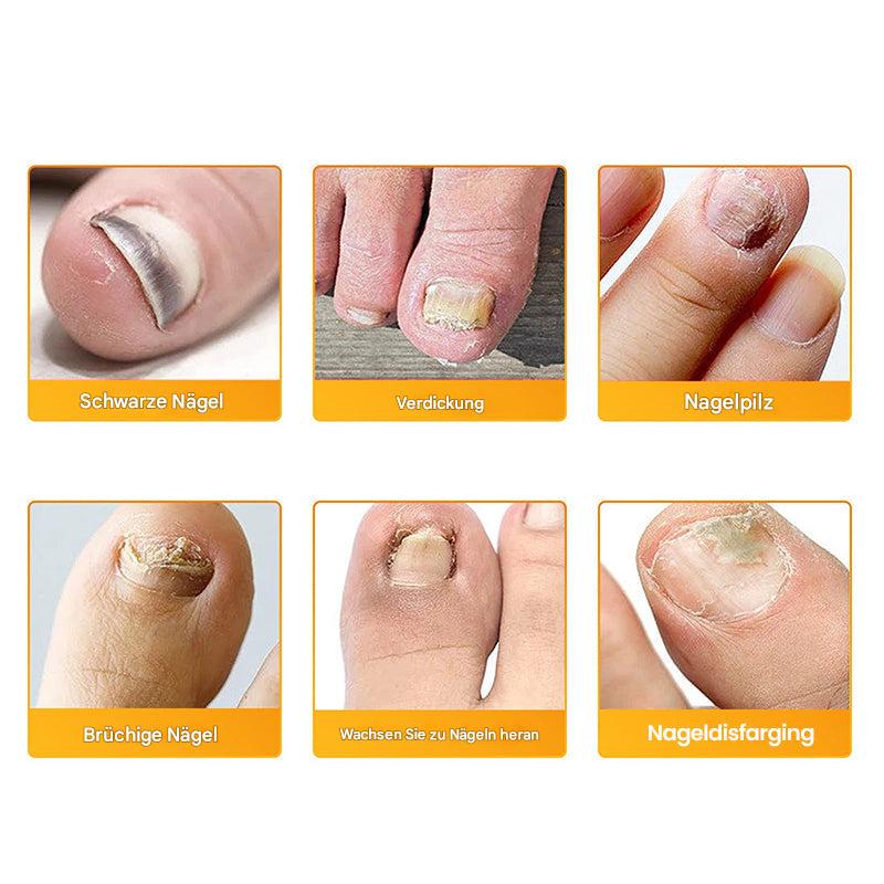 Nailox™ – Voor heldere, gezonde nagels met discrete verzorging de hele dag door [1 + 1 Gratis]