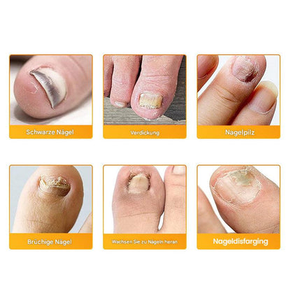 Nailox™ – Voor heldere, gezonde nagels met discrete verzorging de hele dag door [1 + 1 Gratis]