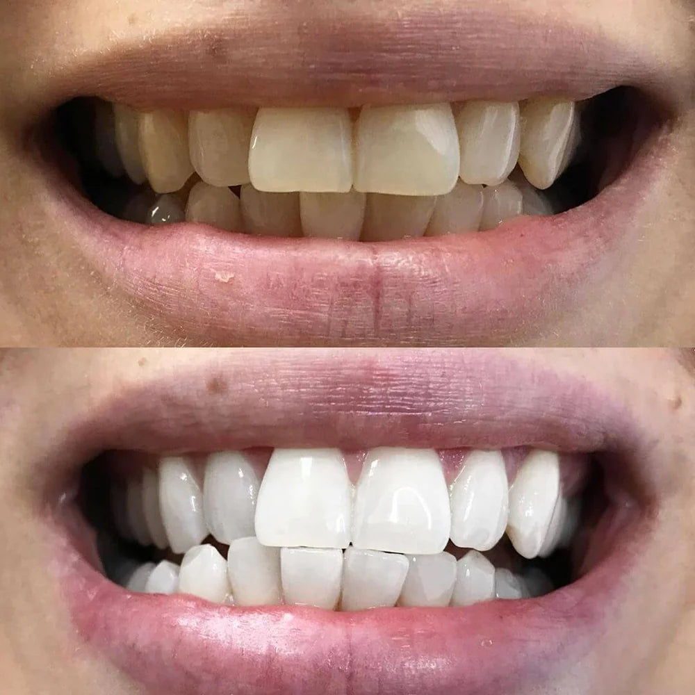 WhiteBoost™ – Straal uit met een glimlach die elke kamer domineert [1 + 1 Gratis]