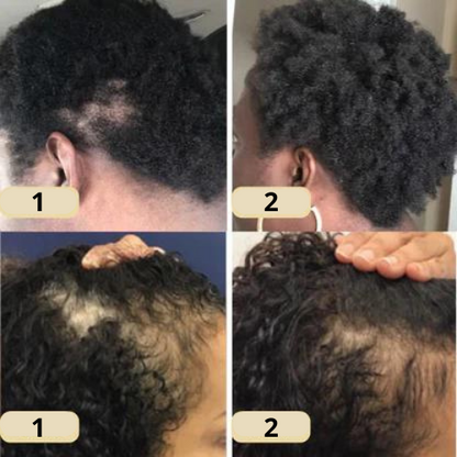 GrowEssence™ – Natuurlijke oplossing voor haargroei voor sterk, gezond & vol haar [1 + 1 Gratis]