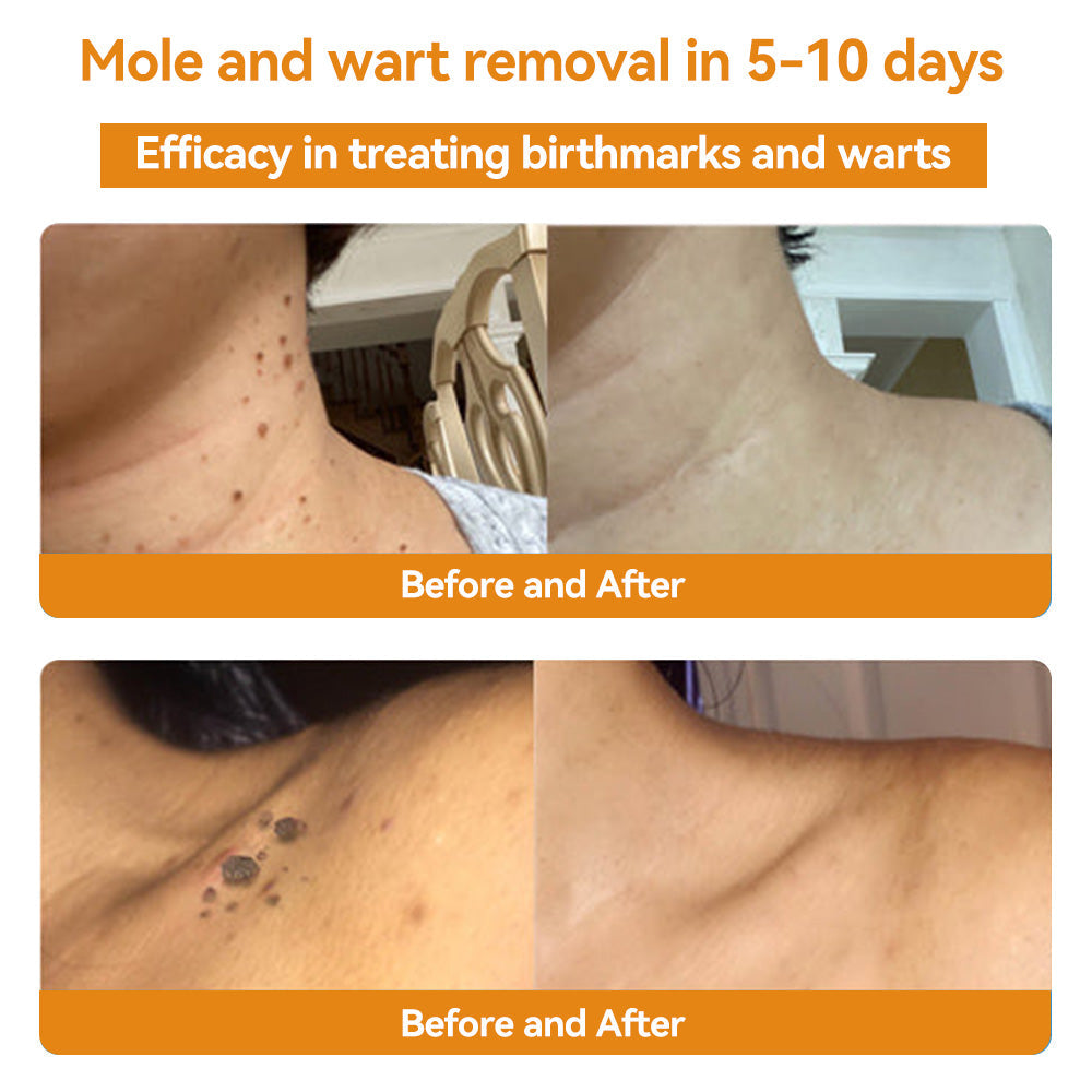 TagRemove™ - Effectieve verwijdering van wratten en huidgezwellen [1 + 1 Gratis]