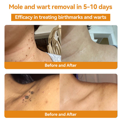 TagRemove™ - Effectieve verwijdering van wratten en huidgezwellen [1 + 1 Gratis]