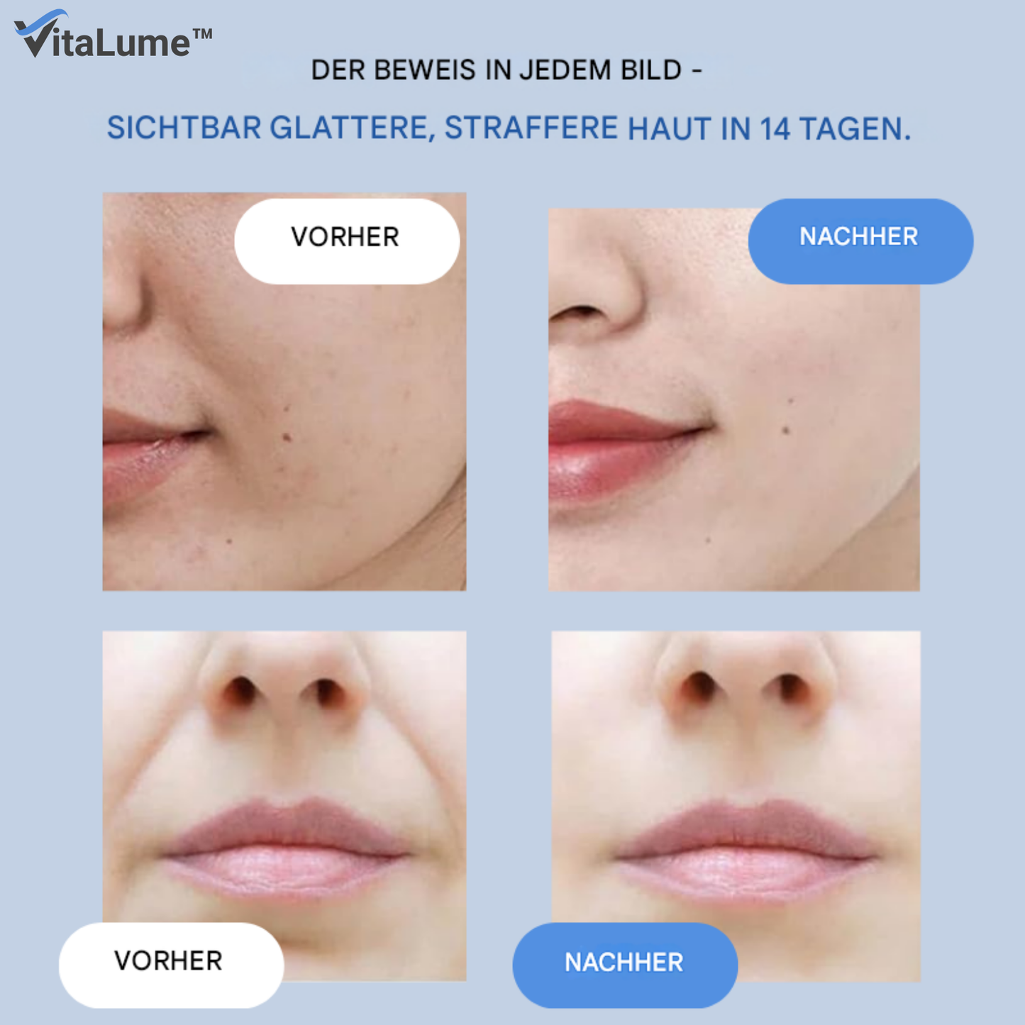 VitaLume™ Rimpelpatches met Hyaluronzuur & Microkristallen – Anti-Aging [1+1 Gratis]