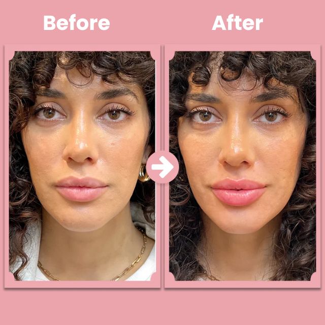 KissBloom™ - Lip lift roller kit [1 + 1 Gratis]
