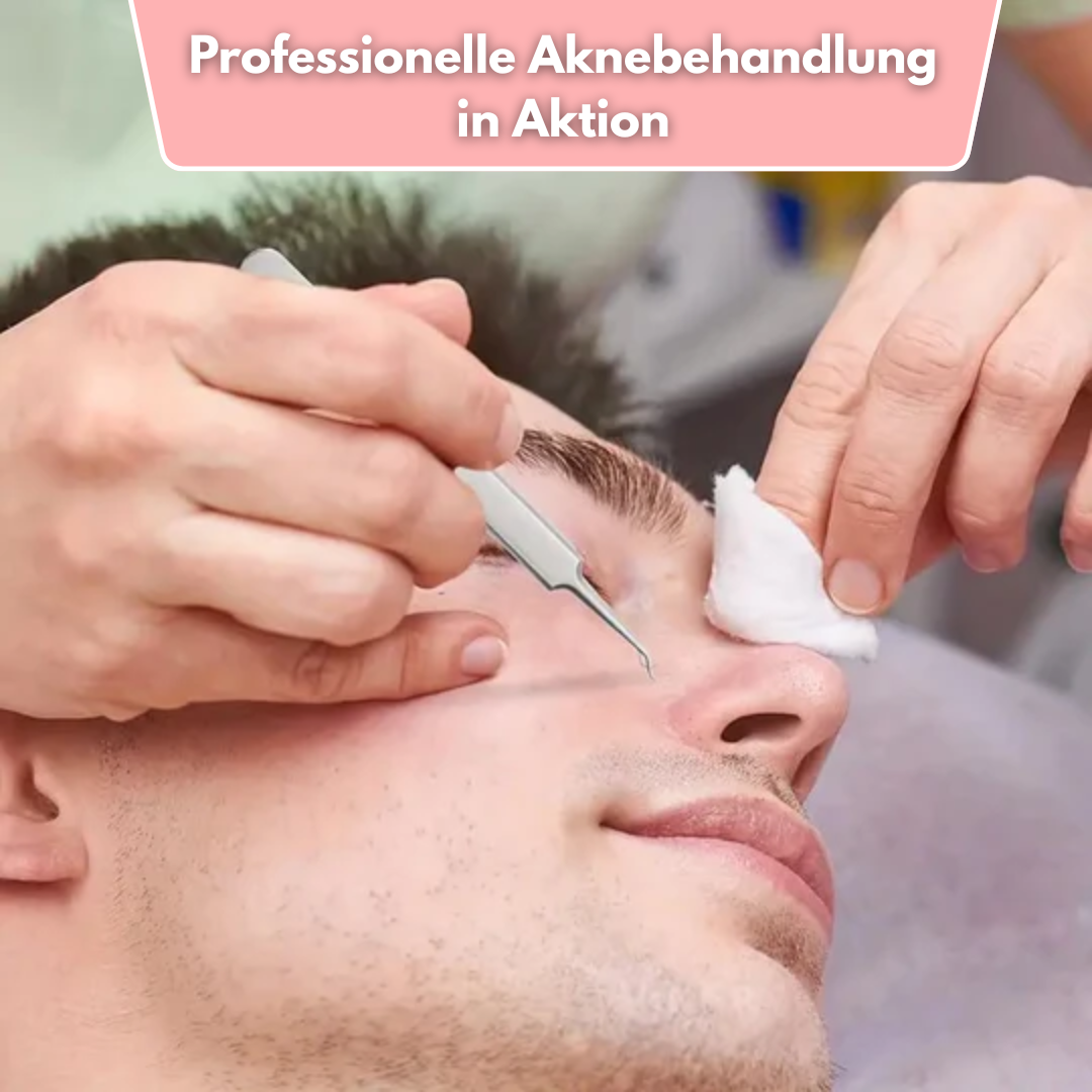 ClearPore™ Mee-eter Verwijderset – Professioneel Pincet voor Acne & Poriën