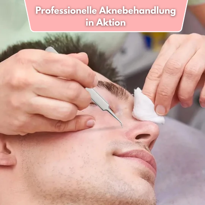 ClearPore™ Mee-eter Verwijderset – Professioneel Pincet voor Acne & Poriën
