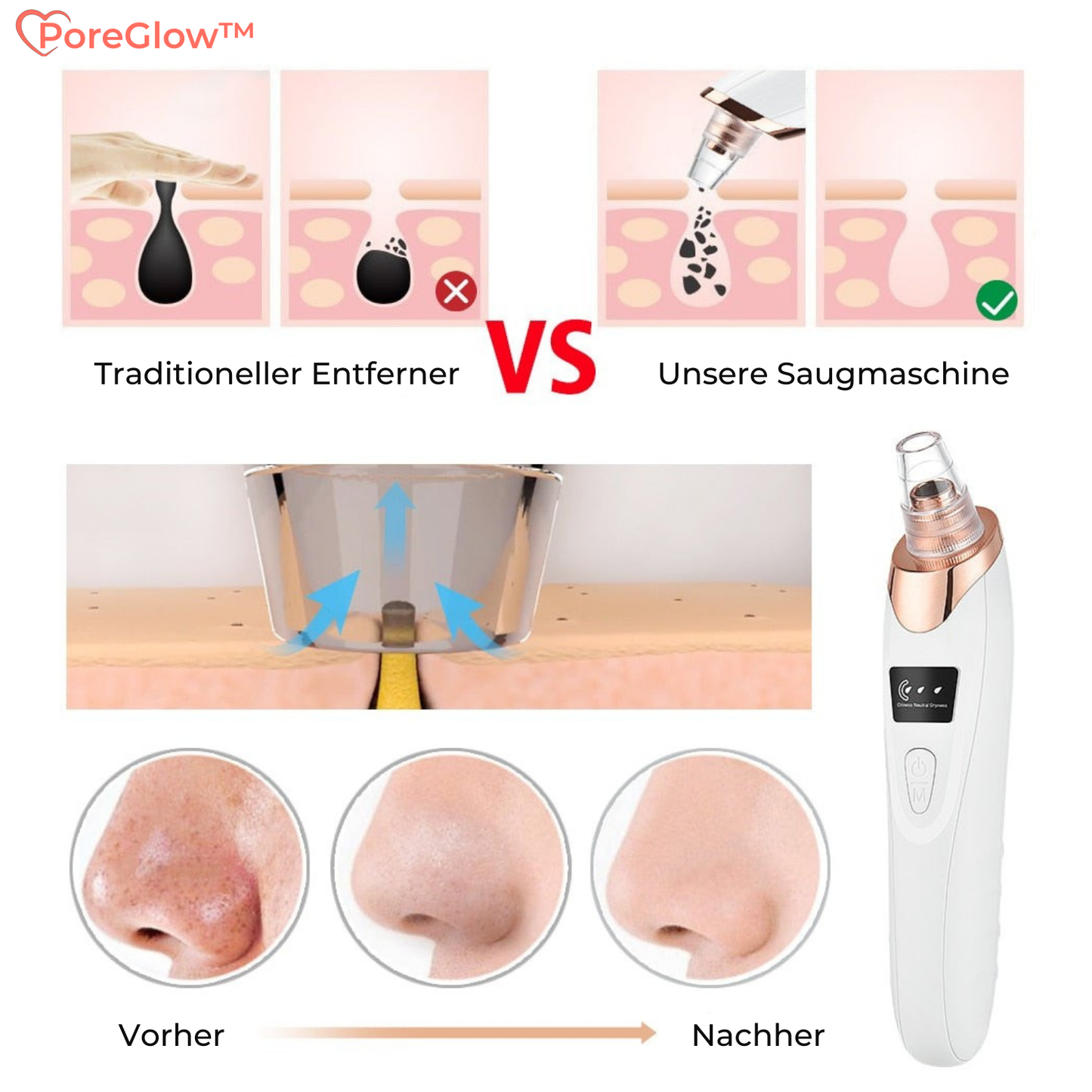 PoreGlow™ – Blackhead Verwijderaar Set voor Diepe Porenreiniging