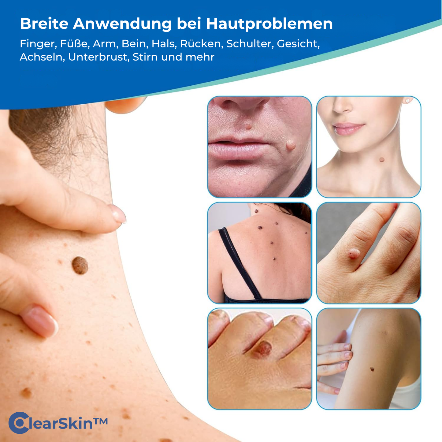 ClearSkin™ Wrattenverwijderaar Pen – Pijnvrije & Snelle Huidbehandeling