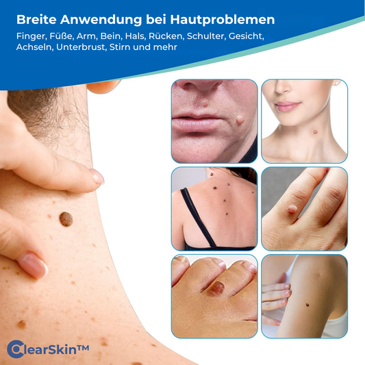 ClearSkin™ – Wrattenverwijderaar-pen voor snelle, effectieve & zachte huidbehandeling [50% Korting]