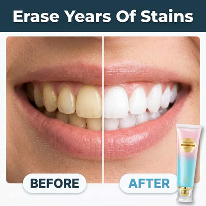 smilebright – Professionele tandbleking voor een stralende glimlach [50% korting]