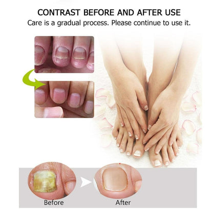 NailReborn™ – Nagelversterker tegen Nagelschimmel & Broze Nagels [1+1 Gratis]