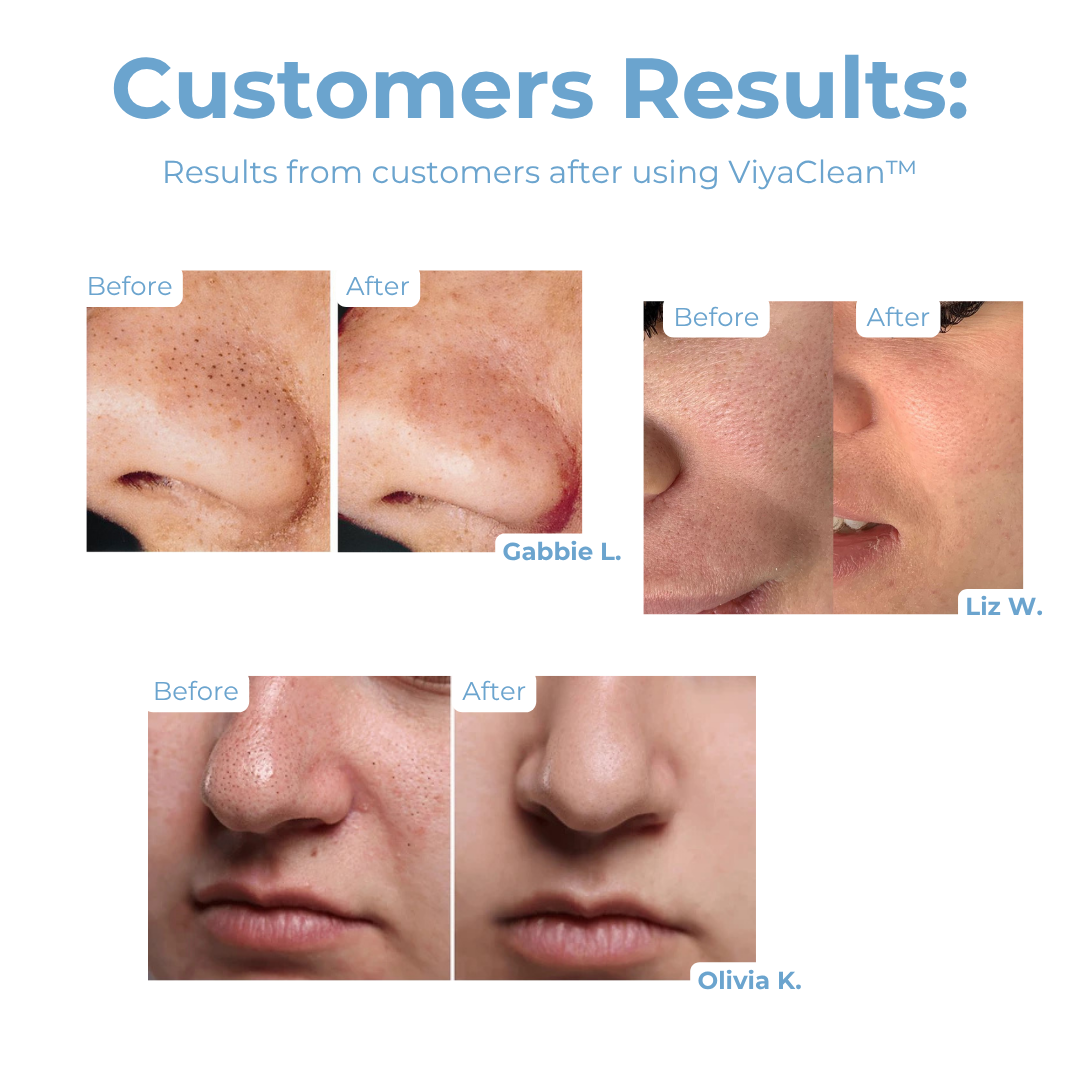 ViyaClean™ – Dieptereiniging Poriënserum voor een Heldere Huid [5+5 Gratis]