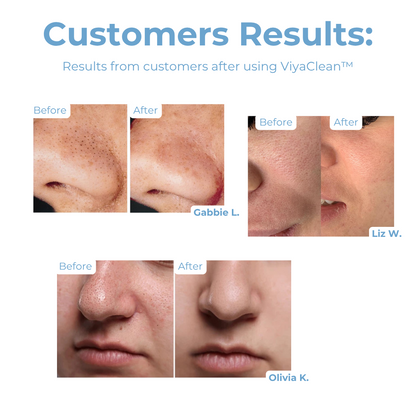 ViyaClean™ – Dieptereiniging Poriënserum voor een Heldere Huid [5+5 Gratis]