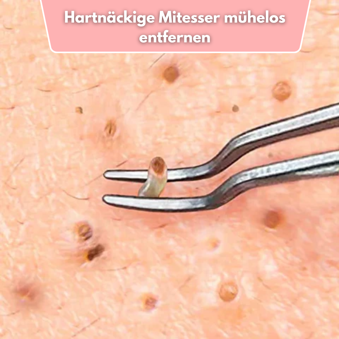 ClearPore™ Mee-eter Verwijderset – Professioneel Pincet voor Acne & Poriën