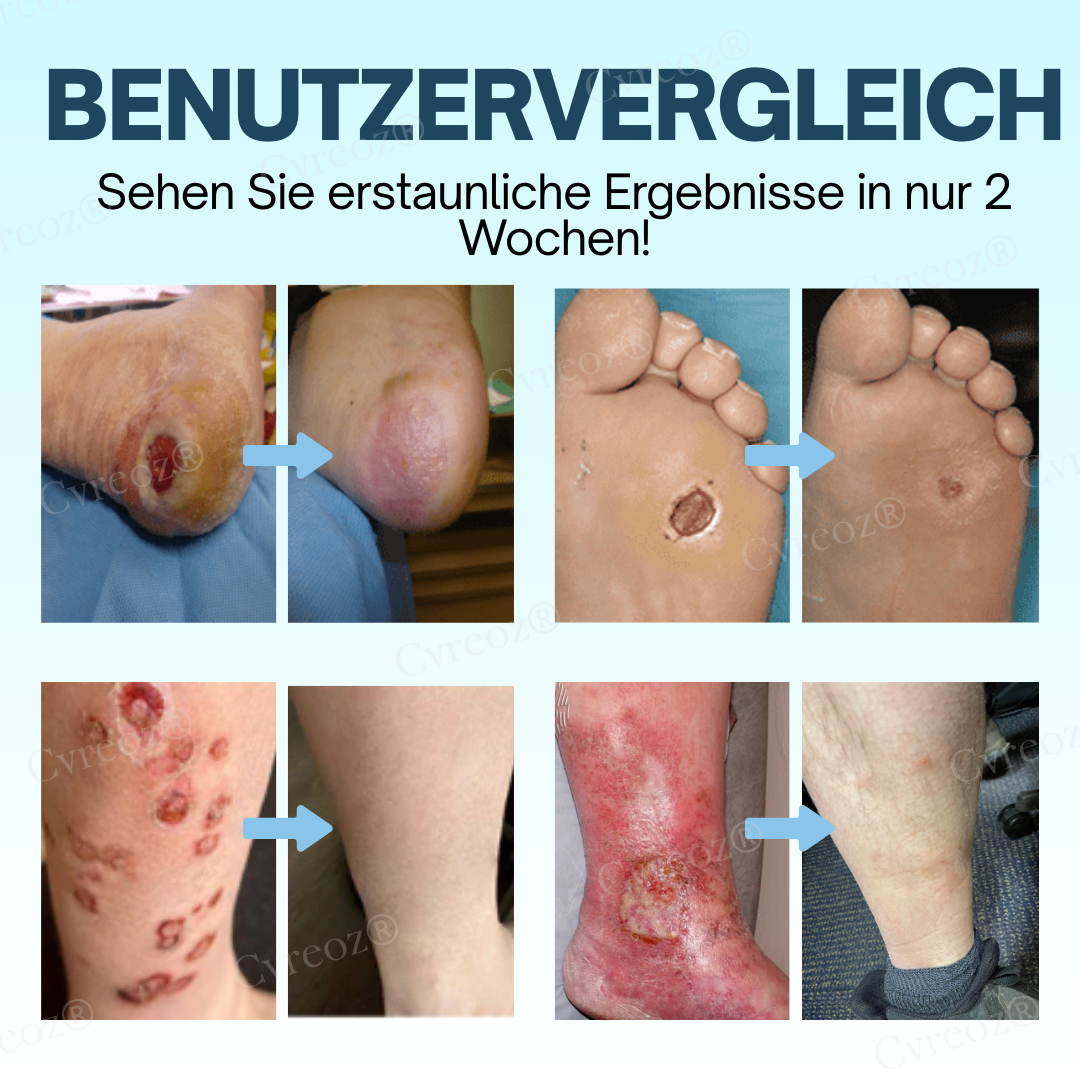 GlucoHeal™ – Hydrateert en beschermt [50% Korting]