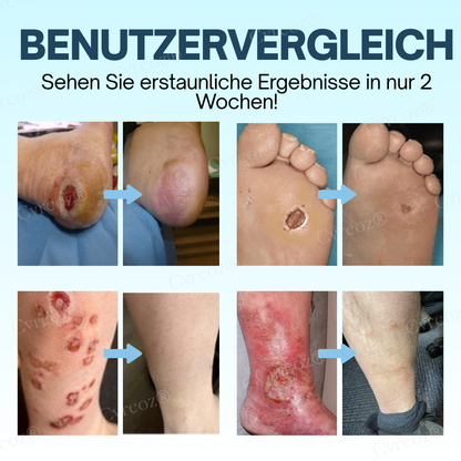 GlucoHeal™ – Hydrateert en beschermt [50% Korting]