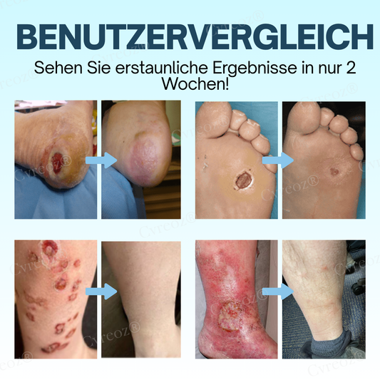 GlucoHeal™ – Hydrateert en beschermt [50% Korting]