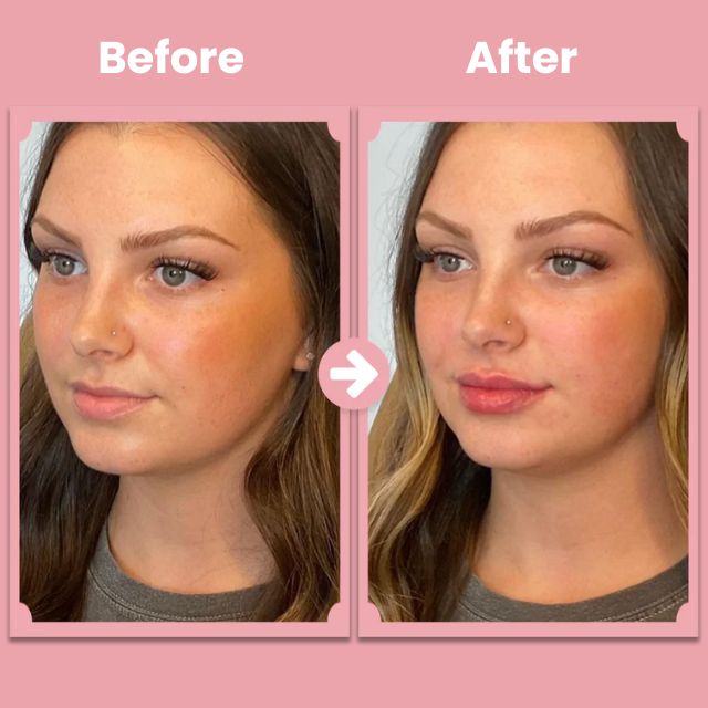 KissBloom™ - Lip lift roller kit [1 + 1 Gratis]