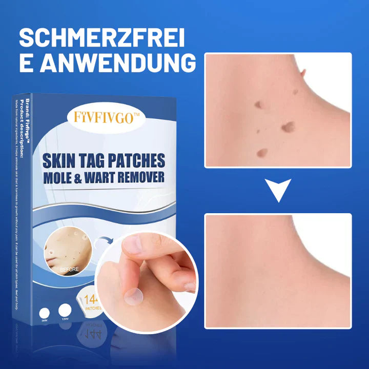 50% korting | TagAway™ - Pleisters voor het verwijderen van huidtags en wratten [laatste dag korting]