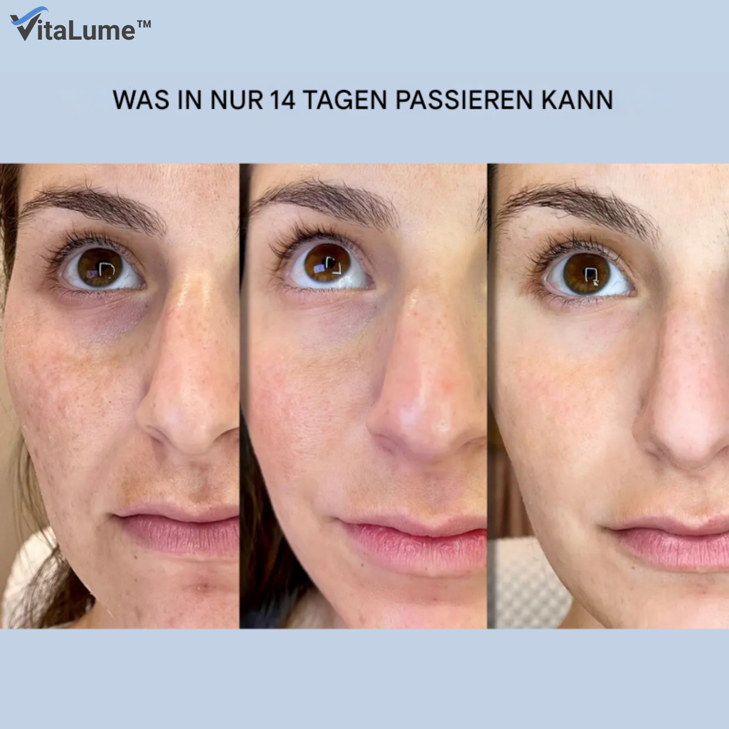 VitaLume™ Rimpelpatches met Hyaluronzuur & Microkristallen – Anti-Aging [1+1 Gratis]