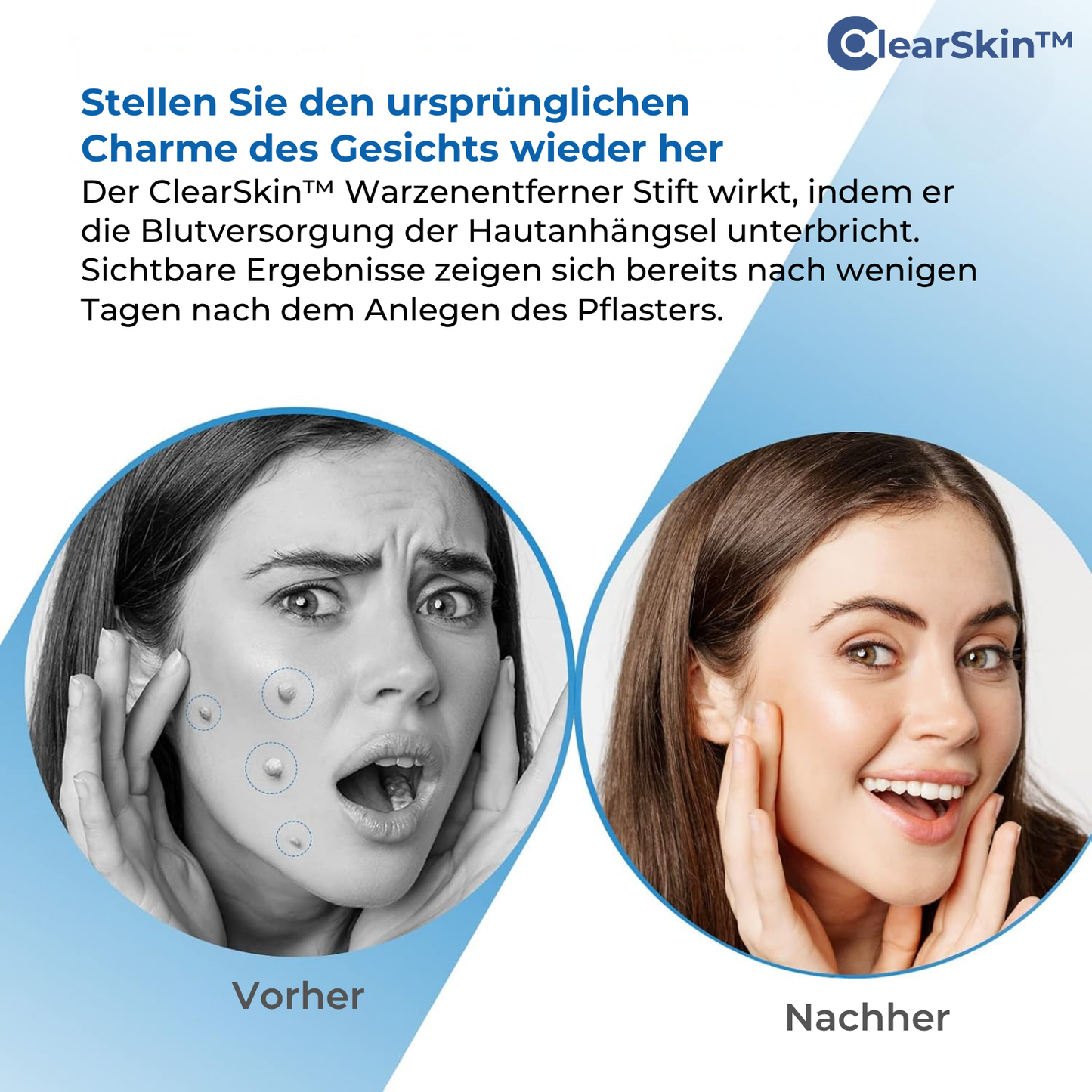 ClearSkin™ Wrattenverwijderaar Pen – Pijnvrije & Snelle Huidbehandeling