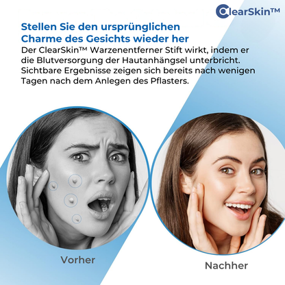 ClearSkin™ Wrattenverwijderaar Pen – Pijnvrije & Snelle Huidbehandeling