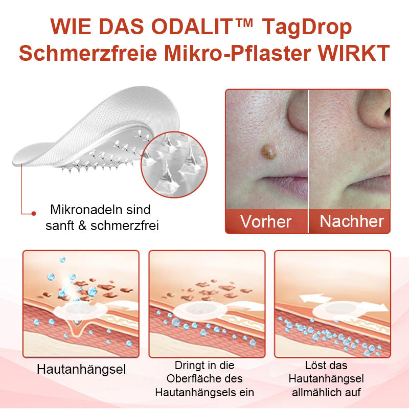 Odalit™ - Pijnloze verwijdering van huidincisies [1 + 1 Gratis]