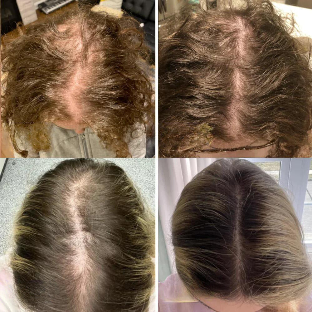 GrowEssence™ – Natuurlijke oplossing voor haargroei voor sterk, gezond & vol haar [1 + 1 Gratis]