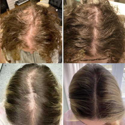 GrowEssence™ – Natuurlijke oplossing voor haargroei voor sterk, gezond & vol haar [1 + 1 Gratis]