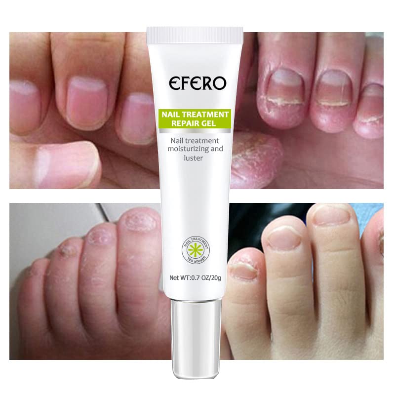 NailRepair™ – Snelle, effectieve en langdurige resultaten [1 + 1 Gratis]