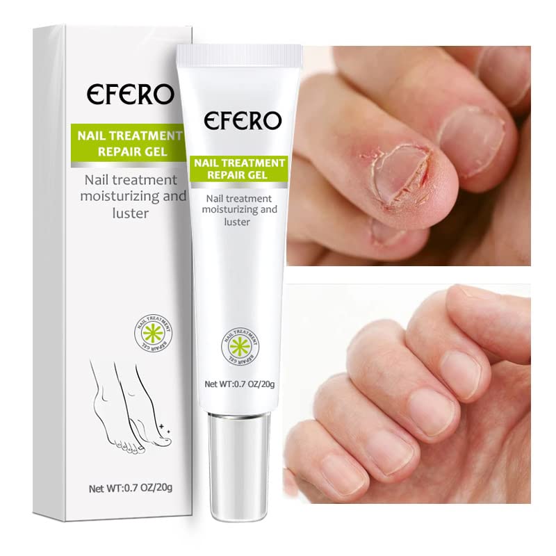 NailRepair™ – Snelle, effectieve en langdurige resultaten [1 + 1 Gratis]