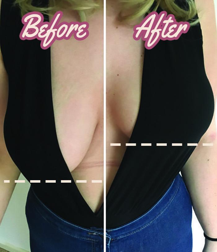 LiftLuxe™ – Borstversteviging Patches | Natuurlijk Lifting Effect