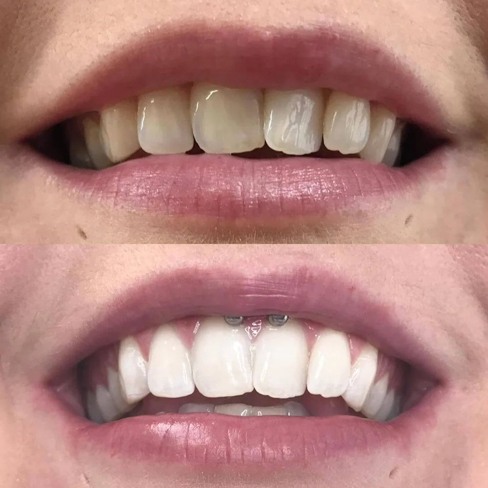 WhiteBoost™ – Straal uit met een glimlach die elke kamer domineert [1 + 1 Gratis]