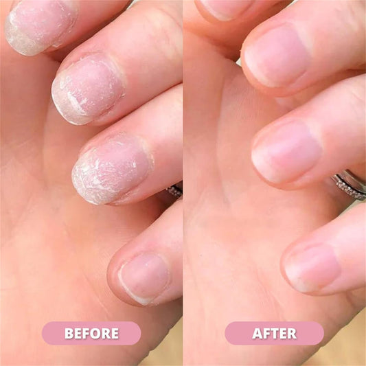 NailShine™ – Hydraterend en versterkend, met vitamine E, C en B7 voor gezonde, glanzende nagels [50% Korting]