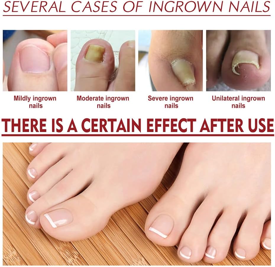 NailHeal™ - Herstel van beschadigde nagels in 4 weken [1 + 1 Gratis]