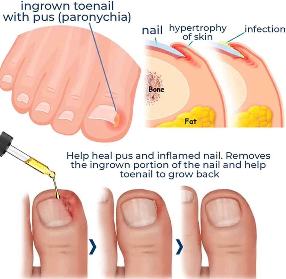 NailHeal™ - Herstel van beschadigde nagels in 4 weken [1 + 1 Gratis]
