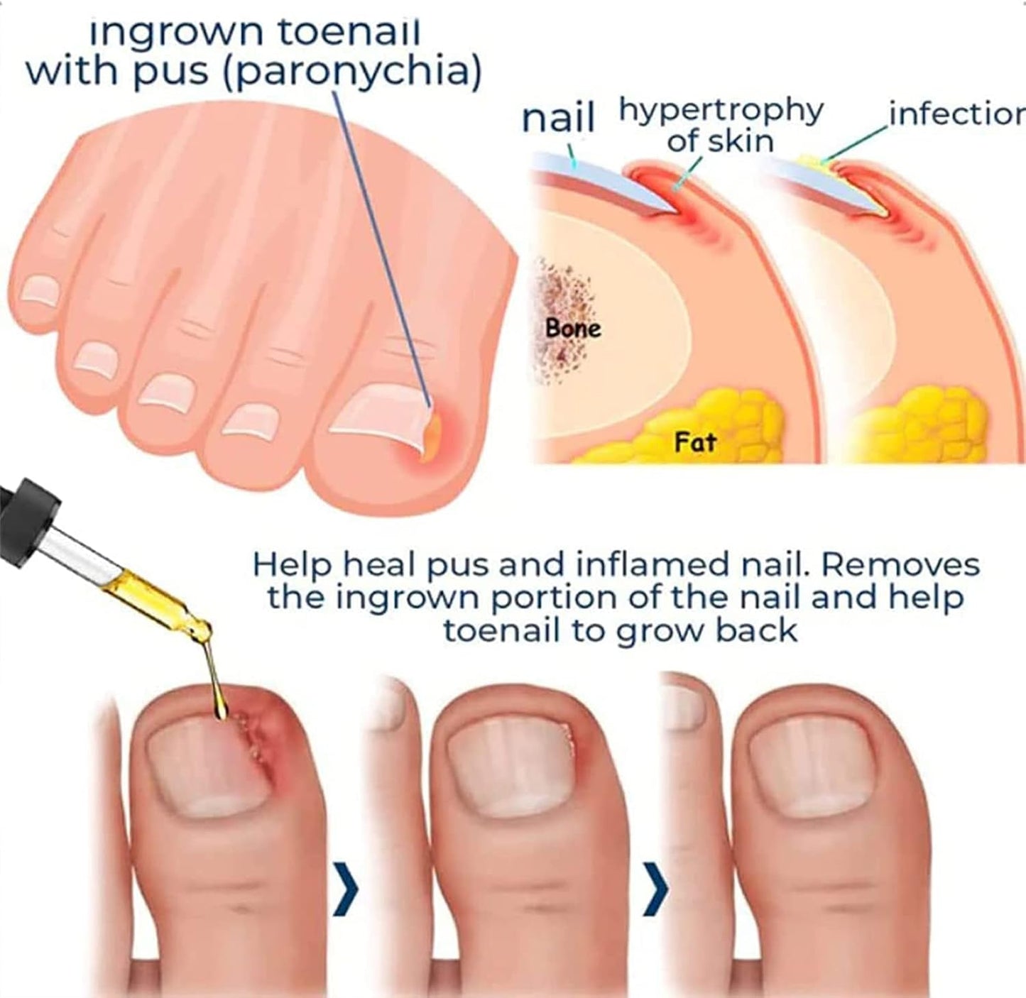 ToePerfect™ Nagelserum – Intensieve Verzorging voor Teen- & Handnagels [1+1 Gratis]
