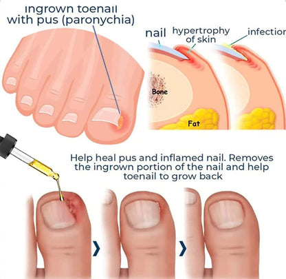 ToePerfect™ Nagelserum – Intensieve Verzorging voor Teen- & Handnagels [1+1 Gratis]