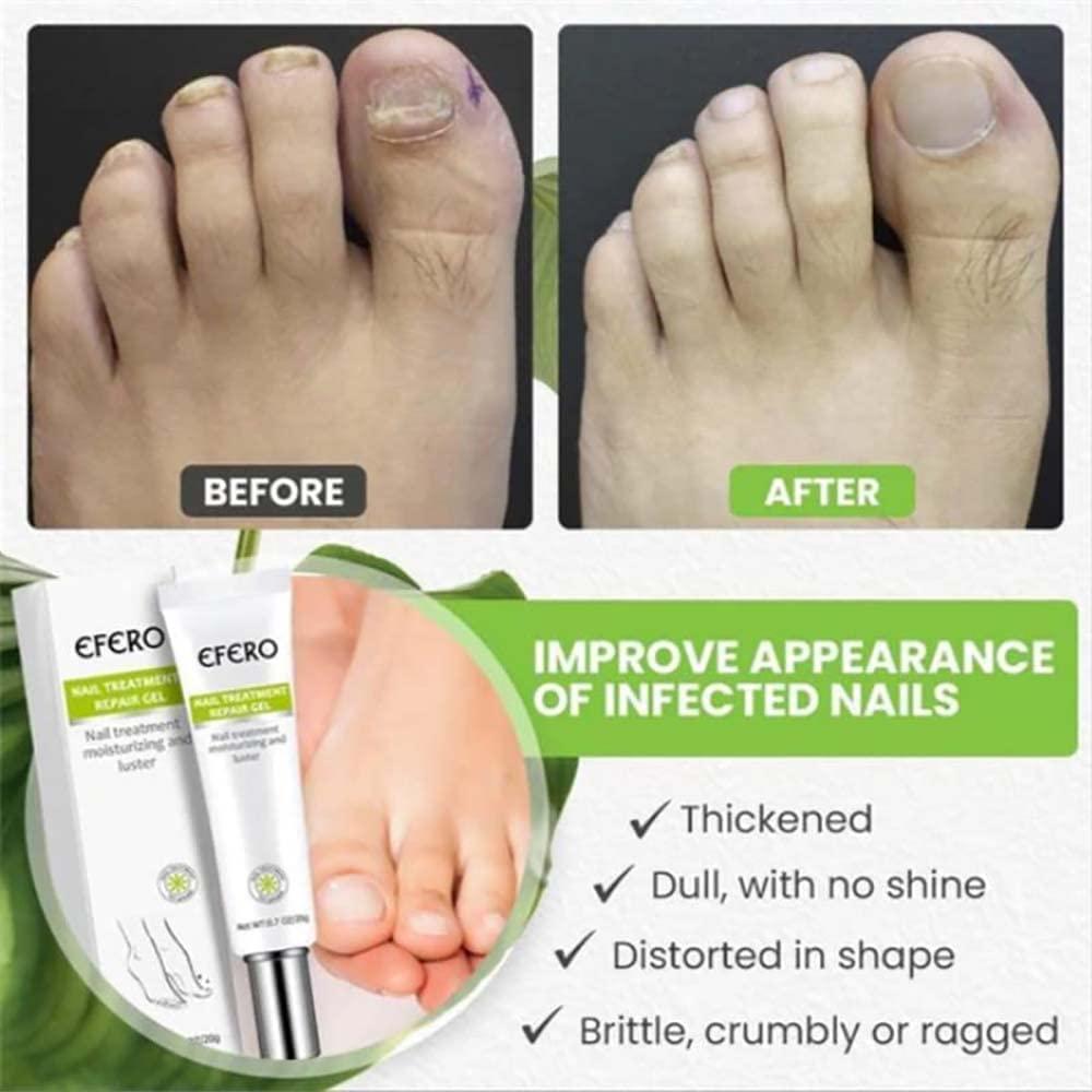 RejuveNail™ – Versterkt Duurzaam Gezonde, Mooie Nagels [1 + 1 Gratis]