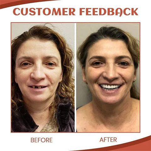 SmileWhite™ - Gebitsprothese set - Zeg vaarwel tegen gebitsprothese ongemak! [50% Korting]