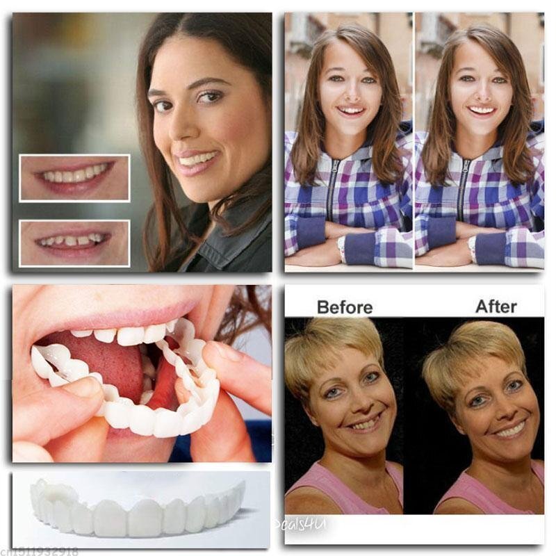 SnapOn™ - Opklikbare prothese voor een stralende lach [1 + 1 Gratis]