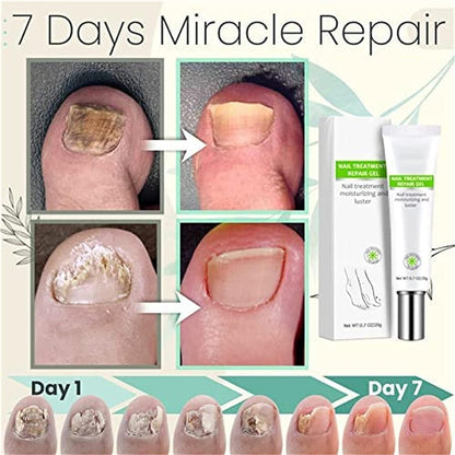 RejuveNail™ – Nagelgel tegen Schimmel & Broze Nagels [1 + 1 Gratis]
