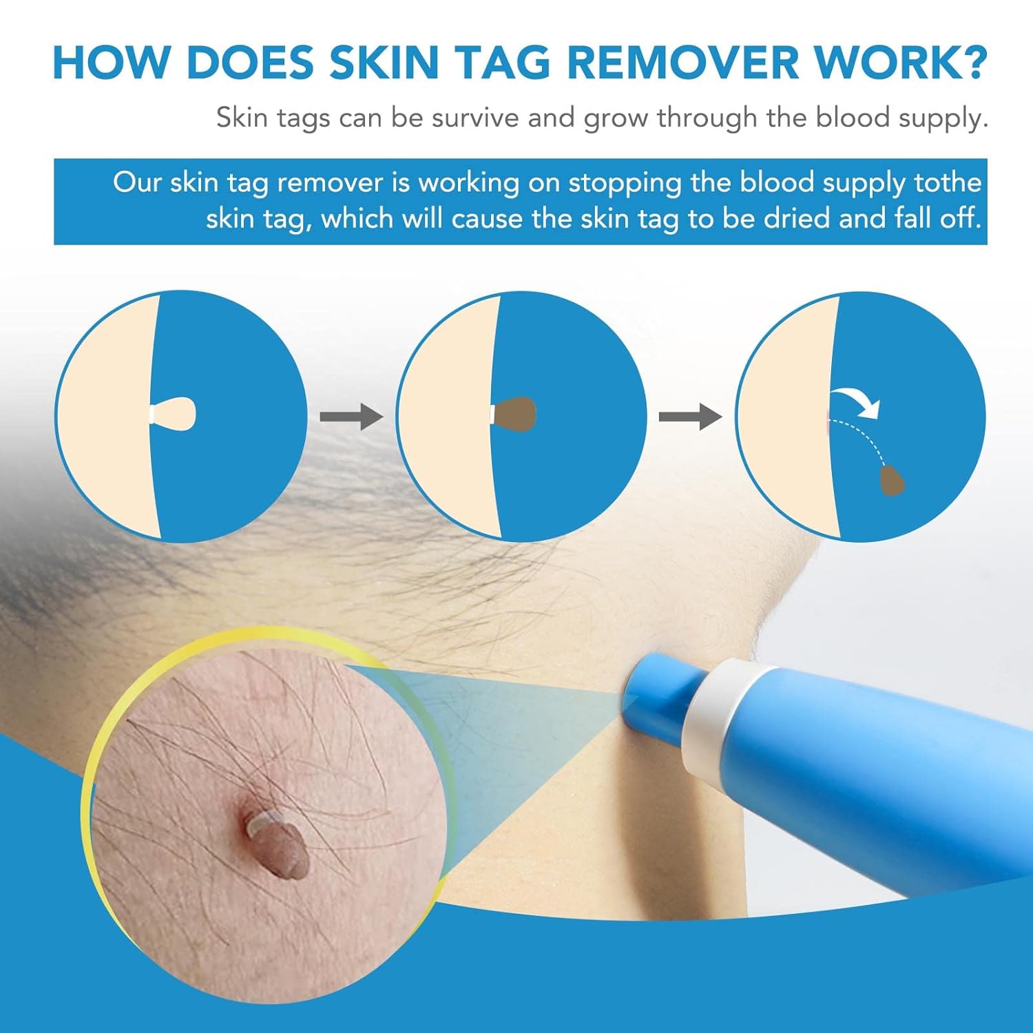 DermaFix™ - Kit voor geavanceerde wratverwijdering [1 + 1 Gratis]