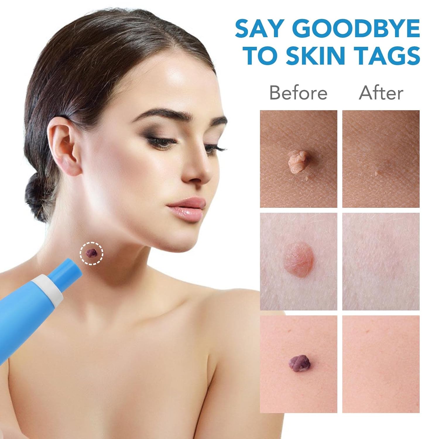 DermaFix™ - Kit voor geavanceerde wratverwijdering [1 + 1 Gratis]